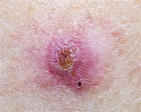 Basal is the most common of skin cancer