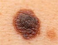 Menanoma is the most serious of skin cancer