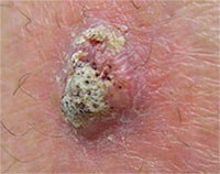 Squamous cell carcinoma is a firm type of skin cancer