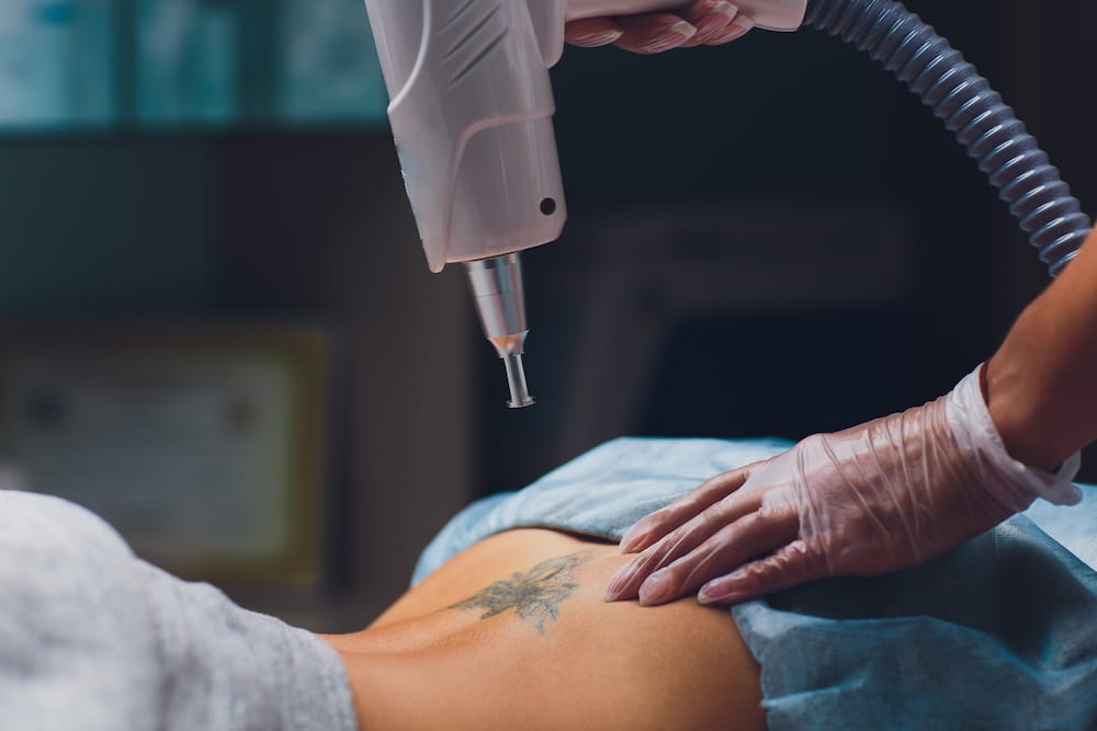 Lower back tattoo being removed by skin experts